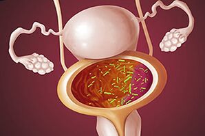 Bakterijski cistitis u ženi